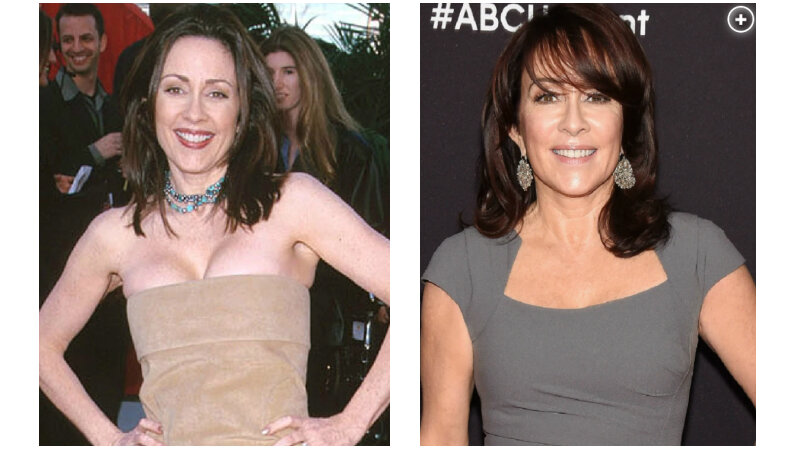 Patricia Heaton breast reduction before and after