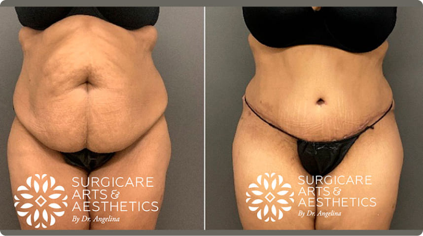 Before And After Tummy Tuck