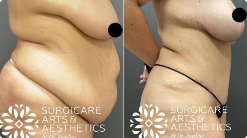 Before And After Tummy Tuck