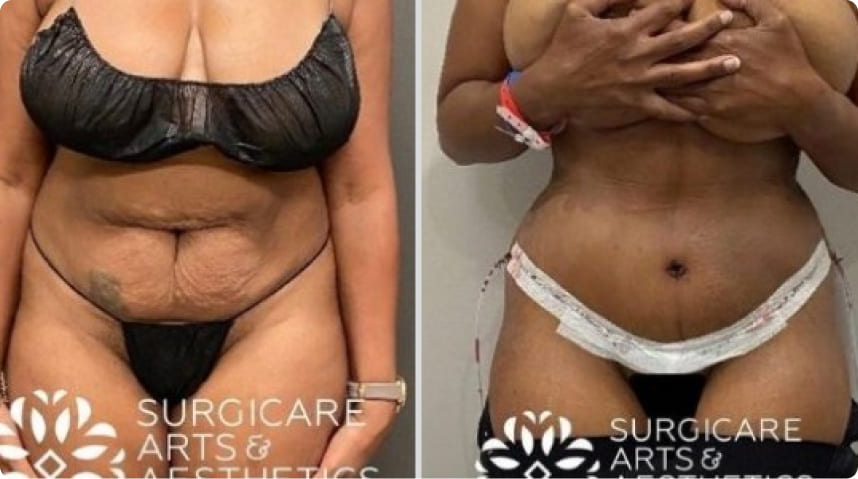 Before And After Tummy Tuck