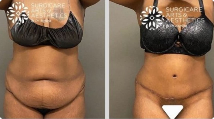 Before And After Tummy Tuck