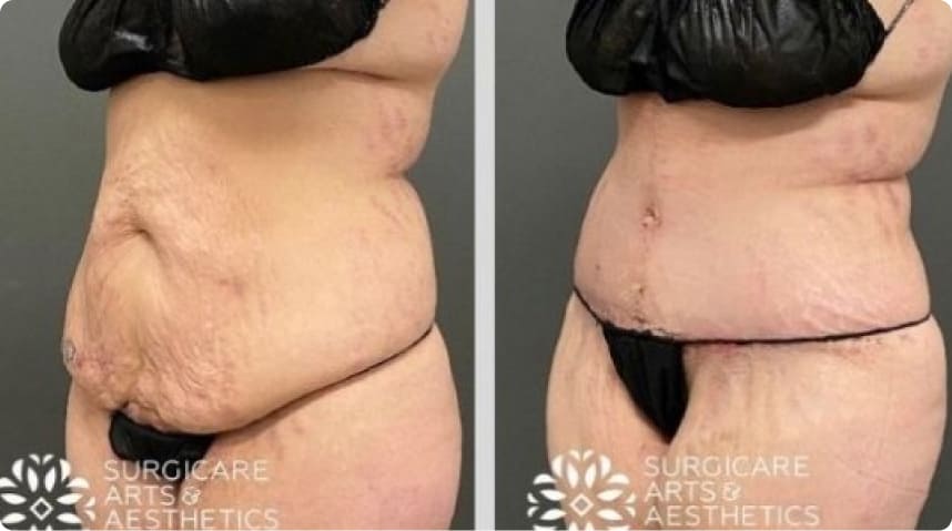 Before And After Tummy Tuck