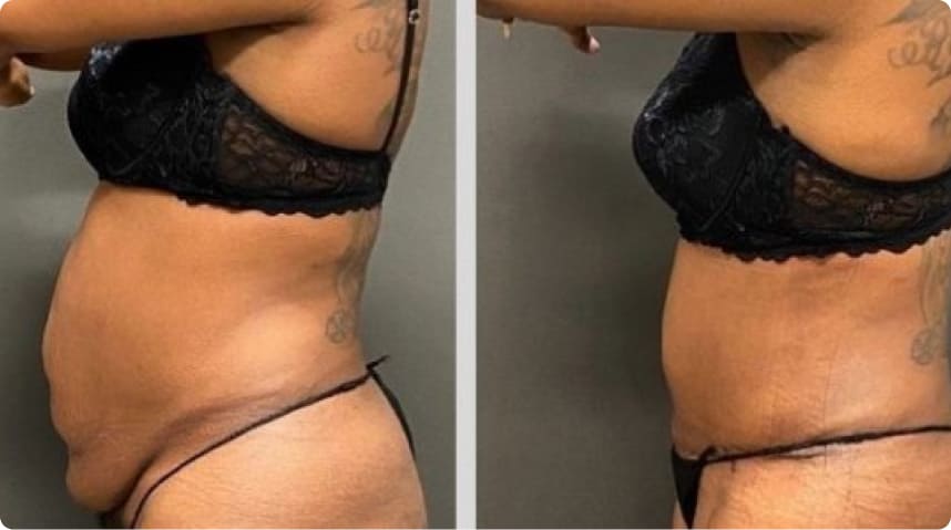 Before And After Tummy Tuck