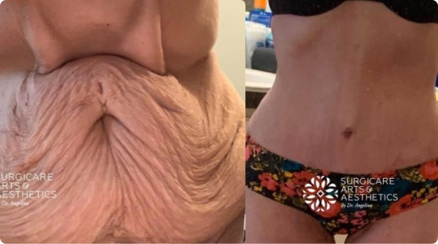 Before And After Tummy Tuck