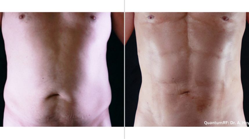 Before And After IgniteRF Body Contouring