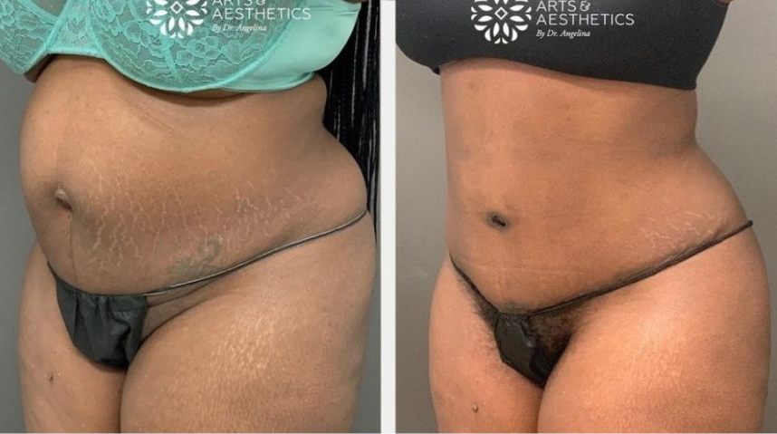 Before And After Body Sculpting
