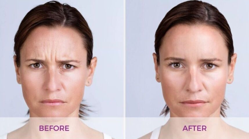 Before And After Xeomin Injections