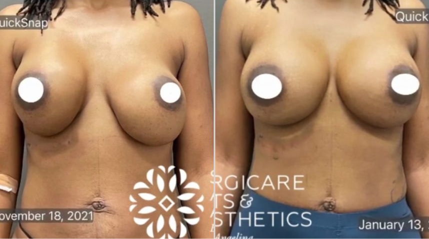 Before And After Xeomin Injections