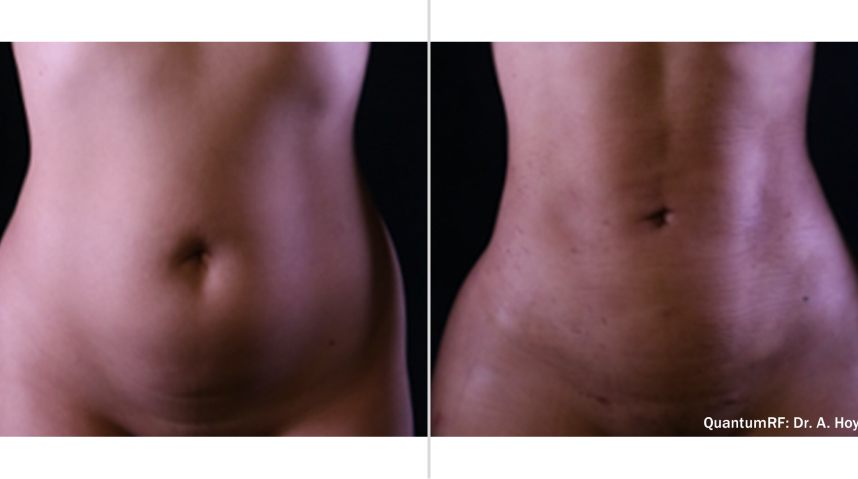 Before And After IgniteRF Body Contouring