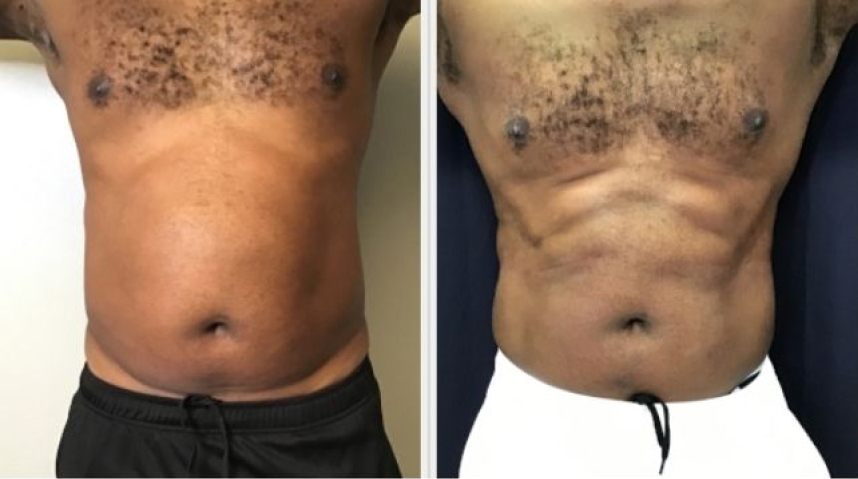 Before And After Body Sculpting