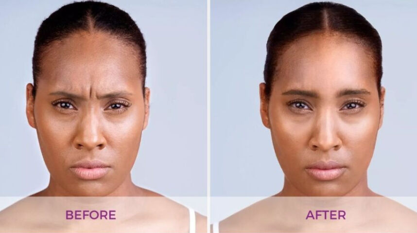 Before And After Xeomin Injections