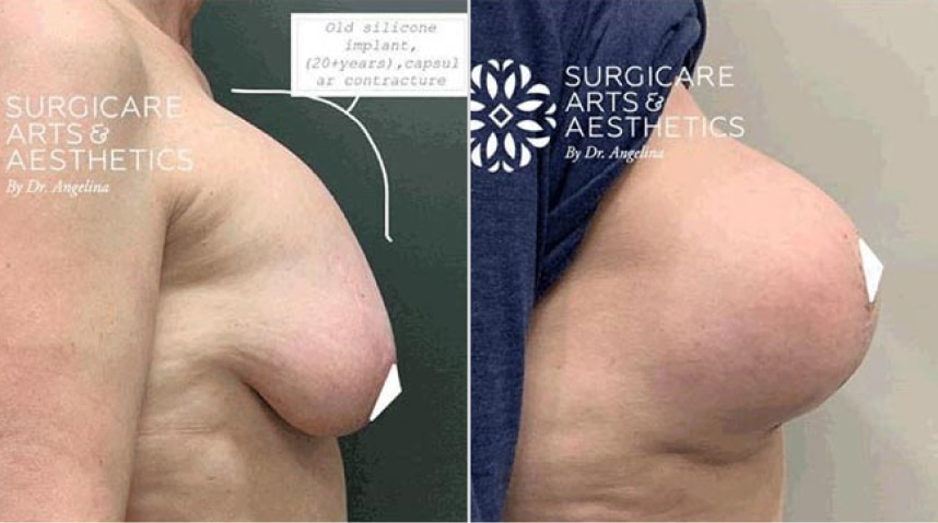 Before And After Xeomin Injections
