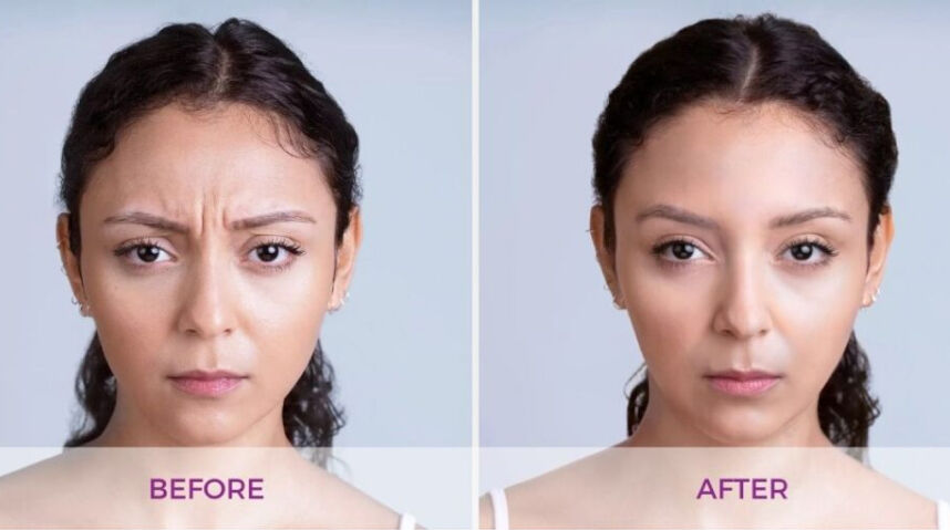 Before And After Xeomin Injections