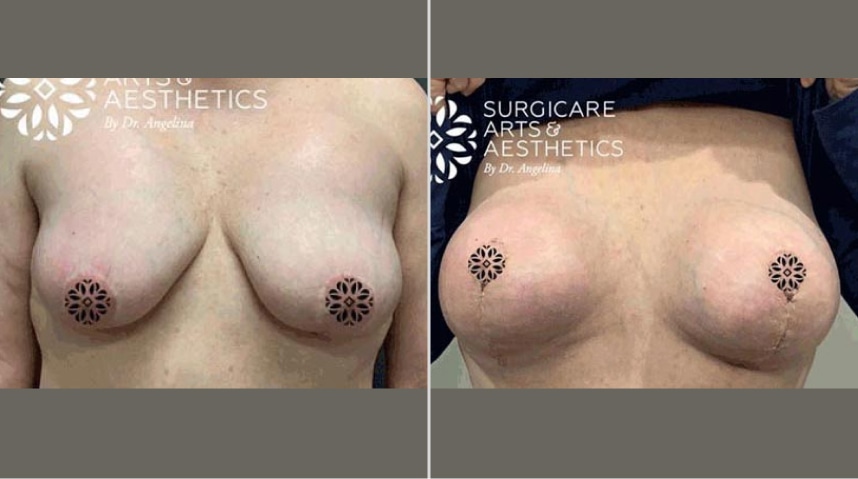 Before And After Xeomin Injections