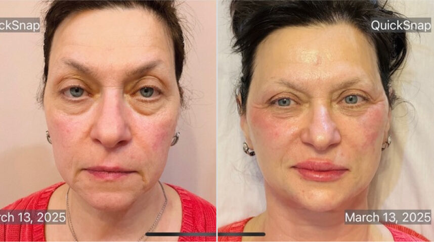 Before And After liquid facelift