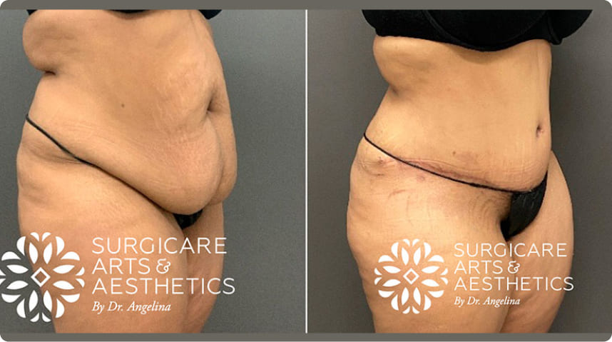 Before And After Tummy Tuck