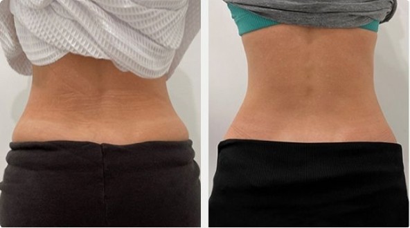 Non-surgical waist contouring with PHYSIQ