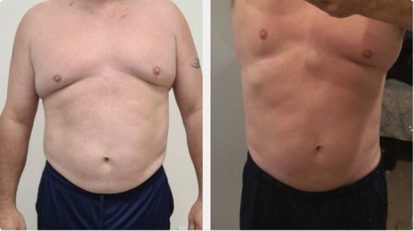 Physiq non-surgical body contouring before and after