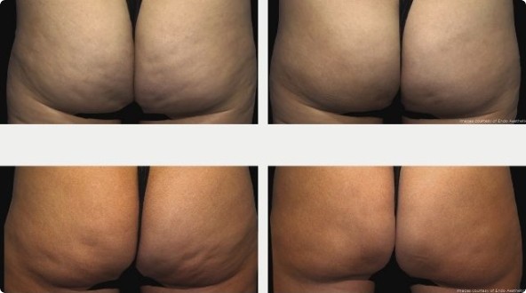 QWO Before and After Results On Cellulite - Buttocks