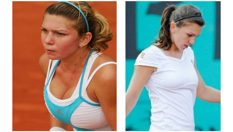 Simona Halep breast reduction before and after