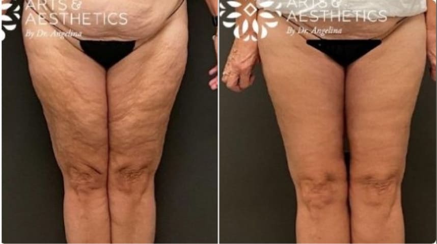 Before And After Thigh Lift