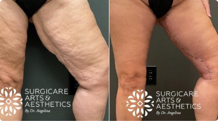 Before And After Thigh Lift