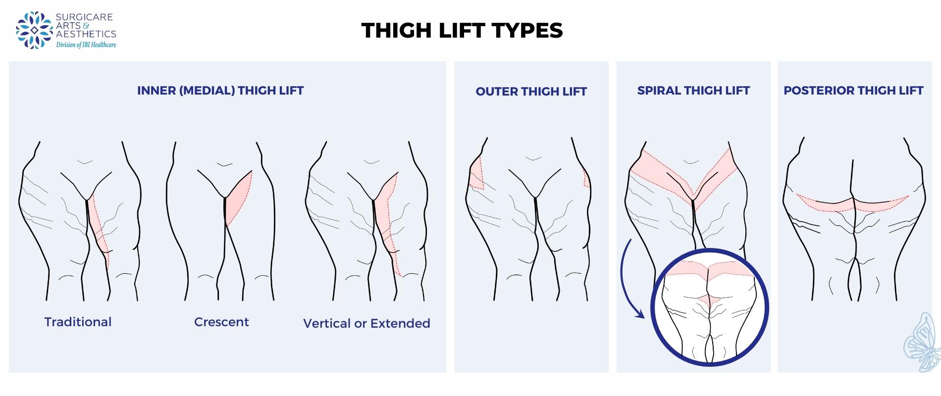 Illustration: Different types of thigh lifts