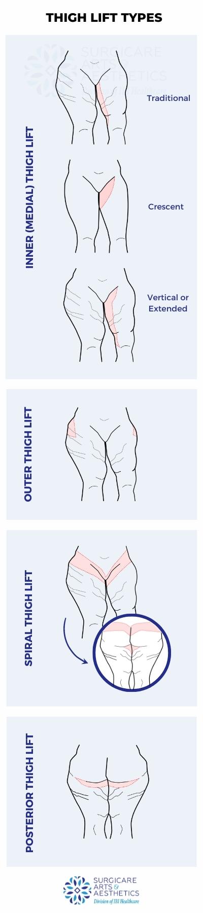 Illustration: Different types of thigh lifts