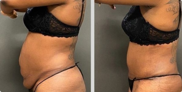 Tummy tuck before and after results