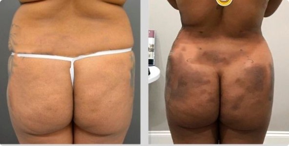 Photos after tummy tuck