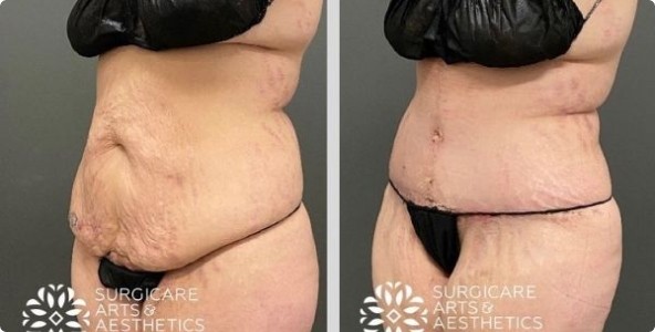 Before and After Fleur de Lis Tummy Tuck
