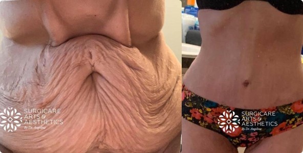 Before and After Tummy Tuck Following Massive Weight Loss With Muscle Diastasis Repair