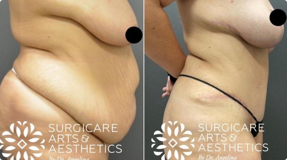 Before And After Tummy Tuck Results With Liposuction, Body and Breast Lifts