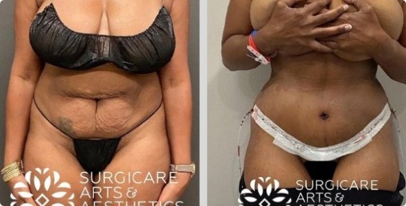 Tummy tuck with lipo before and after
