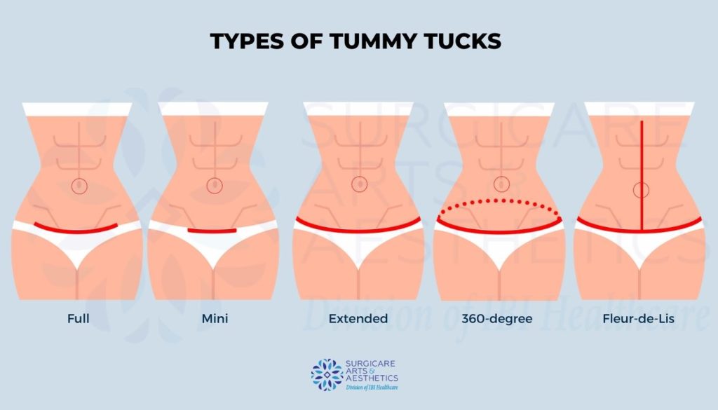 Types of a tummy tuck: mini, full, extended, 360-degree, Fleur-de-Lis