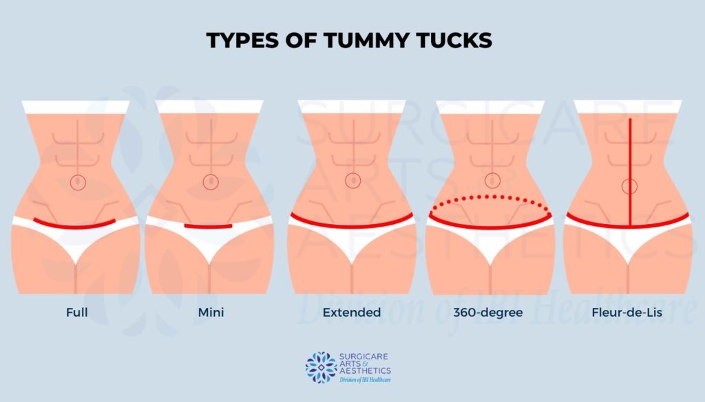 Tummy Tuck Scar Camouflage - Most Popular Treatments