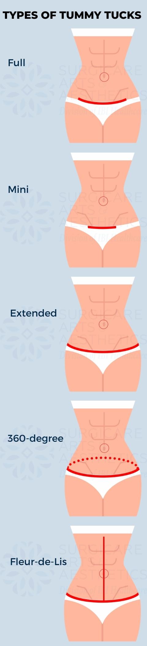 Types of tummy tucks Types of tummy tucks: full, mini, extended, 360-degree, Fleur-de-lis