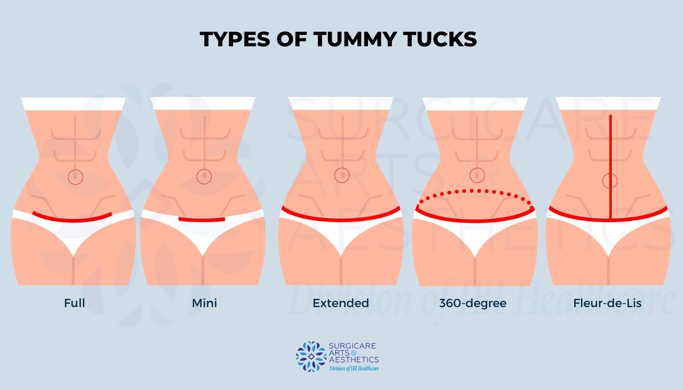 Types of tummy tucks: full, mini, extended, 360-degree, Fleur-de-lis