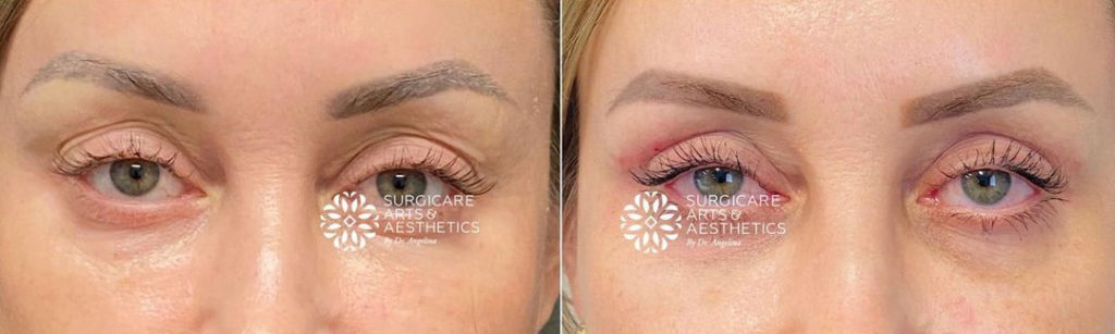 Surgical upper blepharoplasty before and after