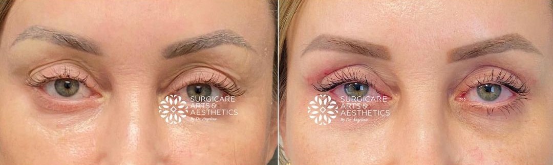 Upper blepharoplasty results