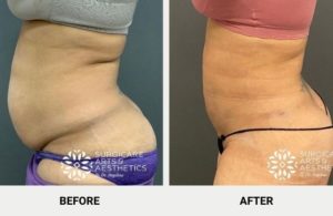 Lipo 360: Fighting And Defeating Fat Around The Midsection