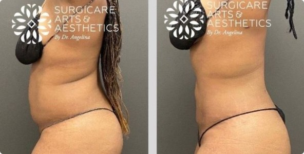 360° VASER liposuction before and after