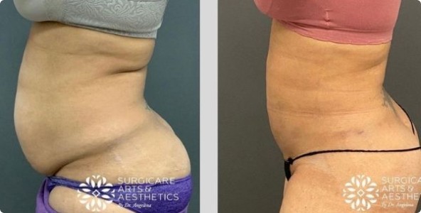 Stomach Liposuction Before And After