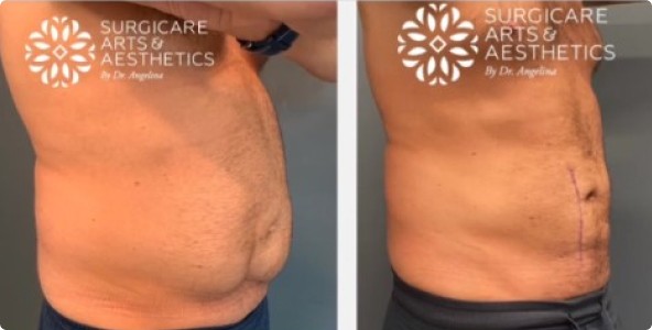 Liposuction Before and After – Pictures After 1 Week and 1 Month