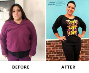 Patient's photos before and after bariatric weight loss surgery