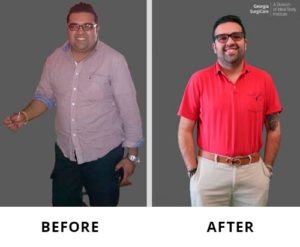 Patient's photos before and after bariatric weight loss surgery